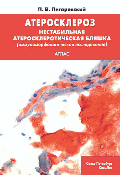 Атеросклероз. Нестабильная атеросклеротическая бляшка (иммуноморфологическое исследование) — П. В. Пигаревский