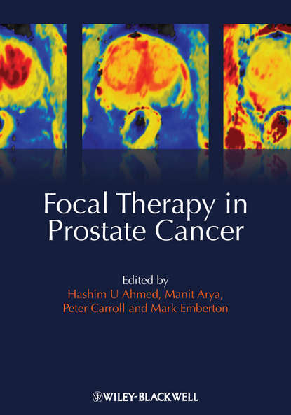 Focal Therapy in Prostate Cancer - Группа авторов