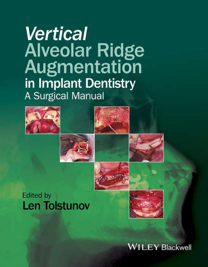 Vertical Alveolar Ridge Augmentation in Implant Dentistry — Группа авторов