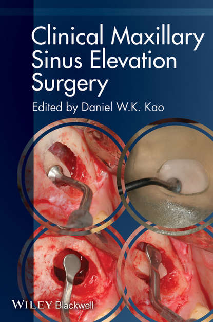 Clinical Maxillary Sinus Elevation Surgery — Группа авторов