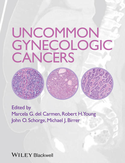 Uncommon Gynecologic Cancers — Группа авторов